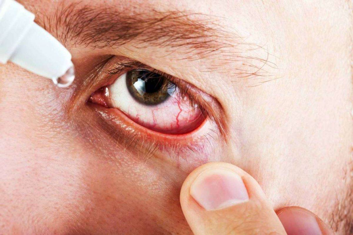 Грибок на глазах: основные симптомы и способы лечения