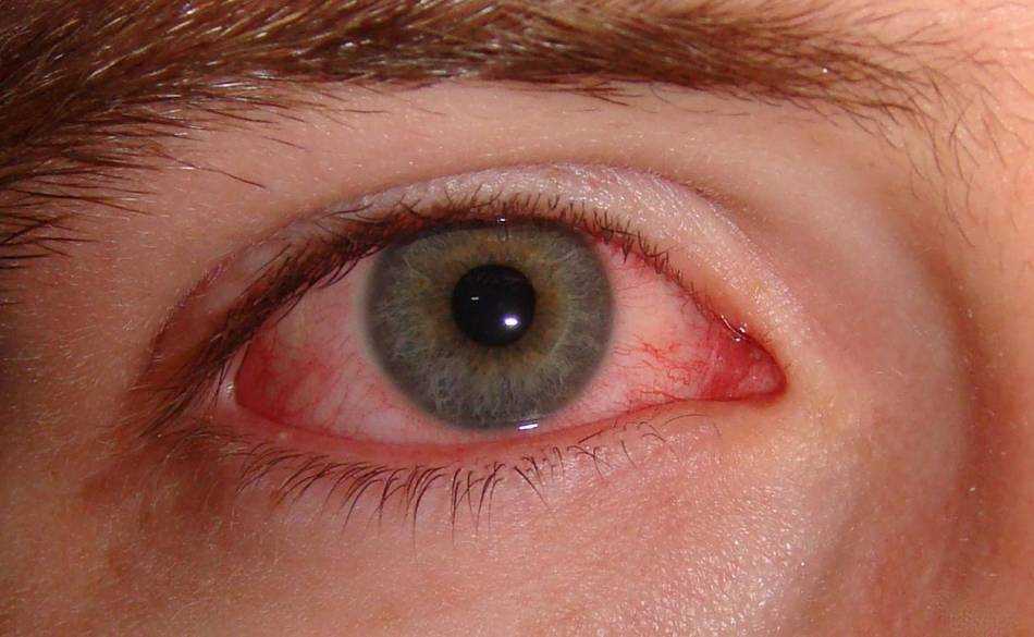 Покраснение глаз: лечение в домашних условиях