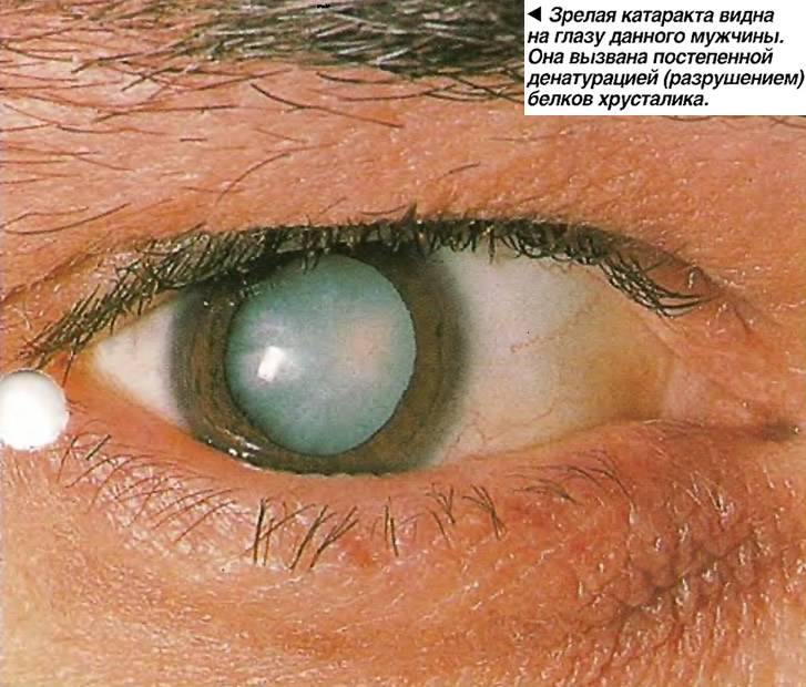 Глаза слепого от рождения | лечение глаз