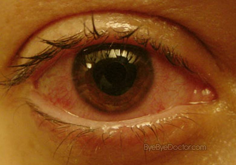 Увеит глаза: симптомы и лечение переднего, заднего увеита