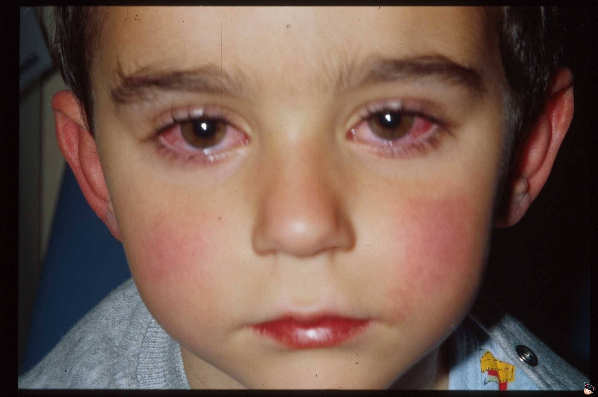 Почему может гноится глаз при простудных заболеваниях, на сколько это опасно и как лечить