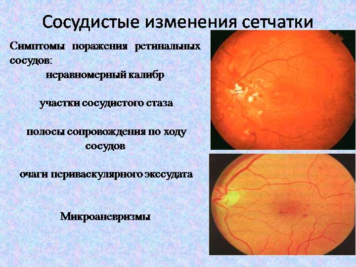 Все про офтальмоскопию (проверку глазного дна)