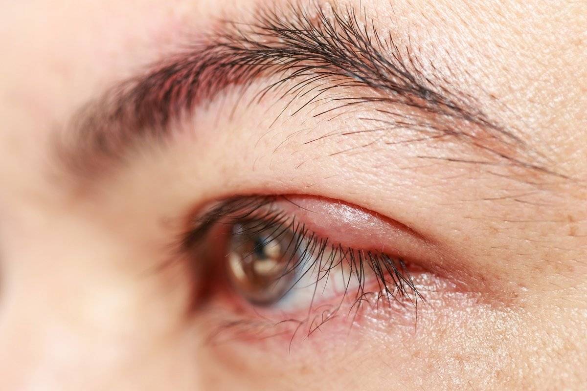 Красные веки глаз: причины у взрослого