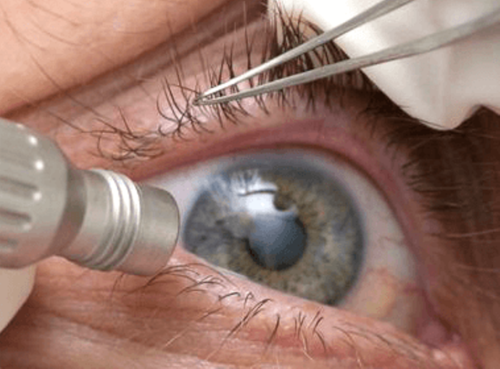 Отслоение сетчатки глаза - операция и восстановительный период