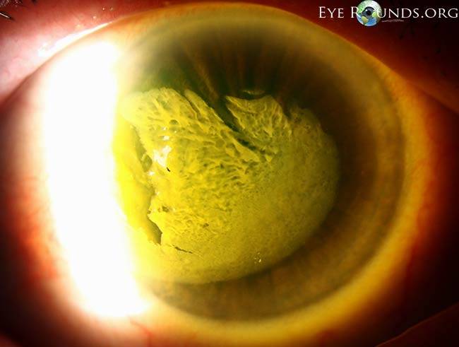 Ожог глаз кварцевой лампой: лечение, первая помощь, возможные последствия и осложнения