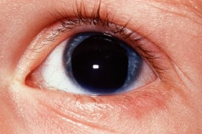 Синдром фукса: гиперхромия глаз, рубеоз в офтальмологии, пятно радужки