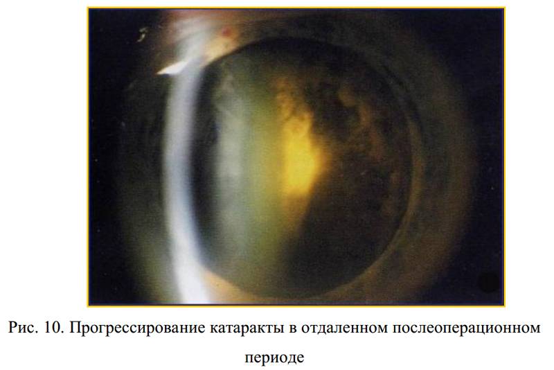 Противопоказания к операции по удалению катаракты: когда нельзя заменить хрусталик
