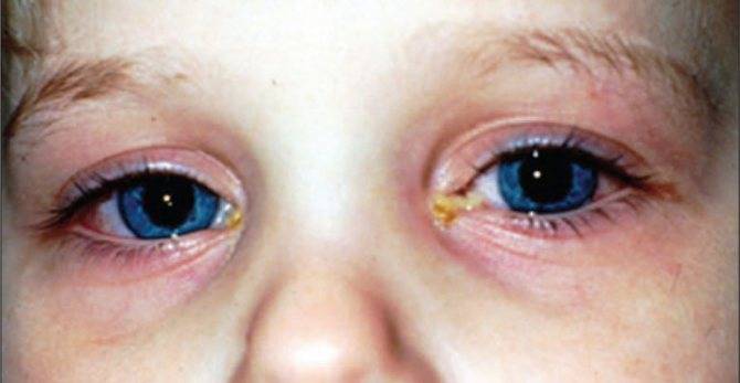 Конъюктивит у детей, симптомы и методы лечения глаз у ребенка