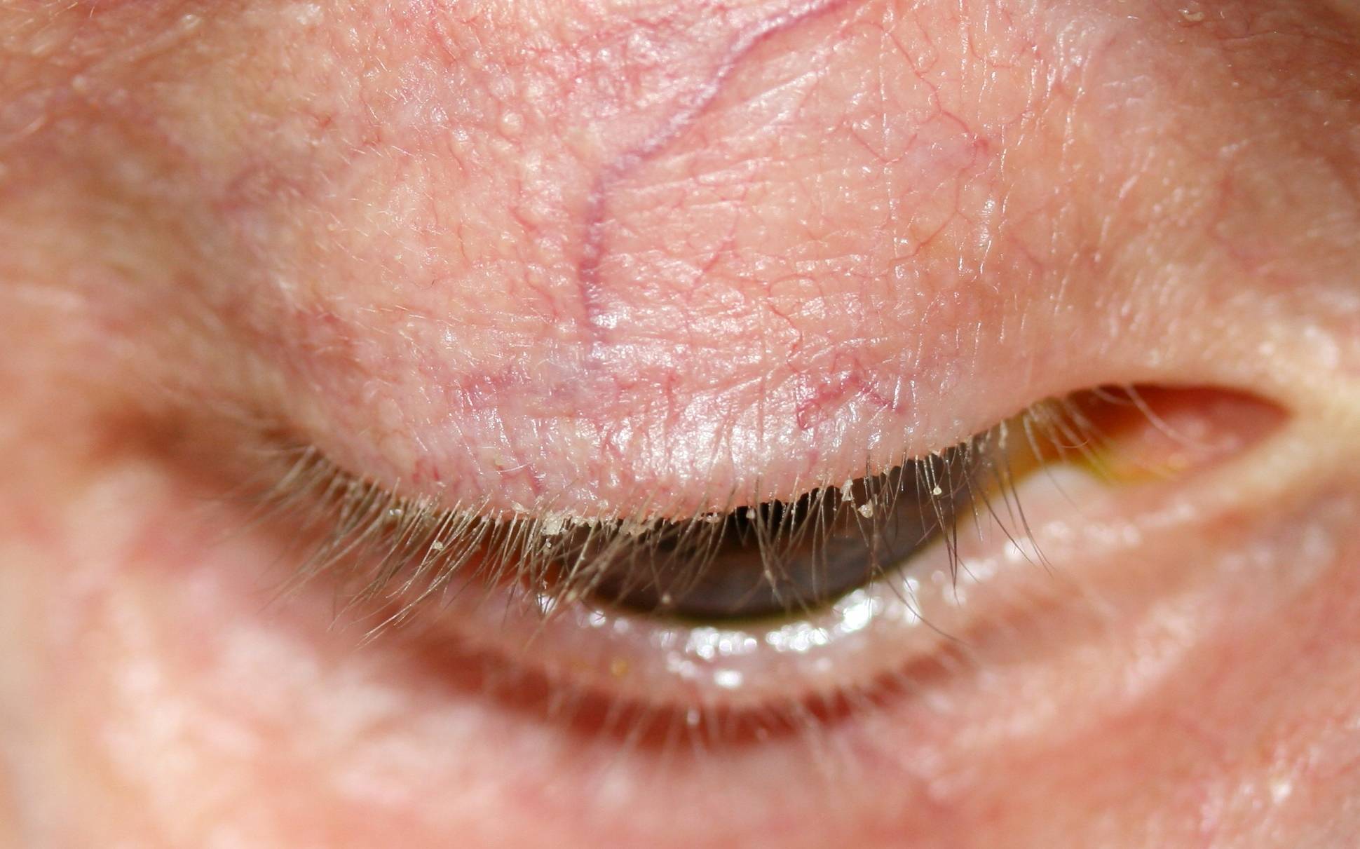 Шелушится веко глаза: причины, симптомы и лечение