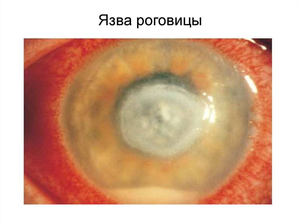 Роговица глаза: повреждения, лечение, препараты для терапии, глазные капли, возможные последствия при травме