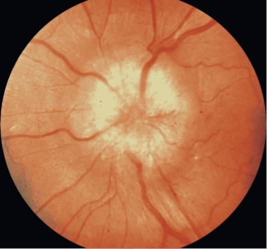 Отек диска зрительного нерва: признаки, лечение, осложнения — онлайн-диагностика