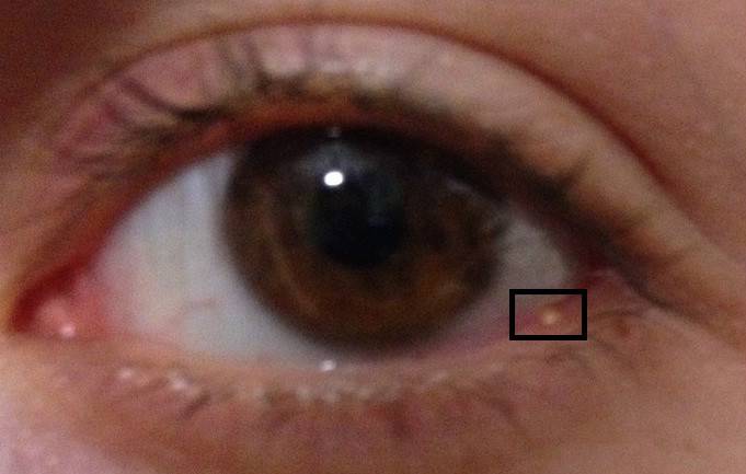 Почему в уголках глаз собирается белый налет — основные причины, лечение