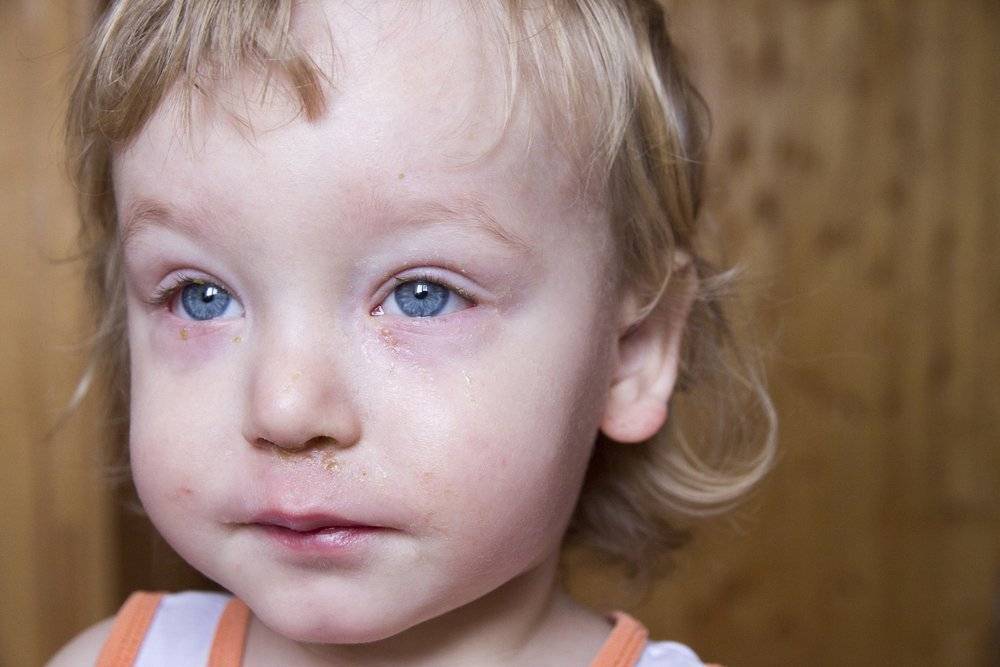 Красные глаза и насморк у ребенка - причины, лечение