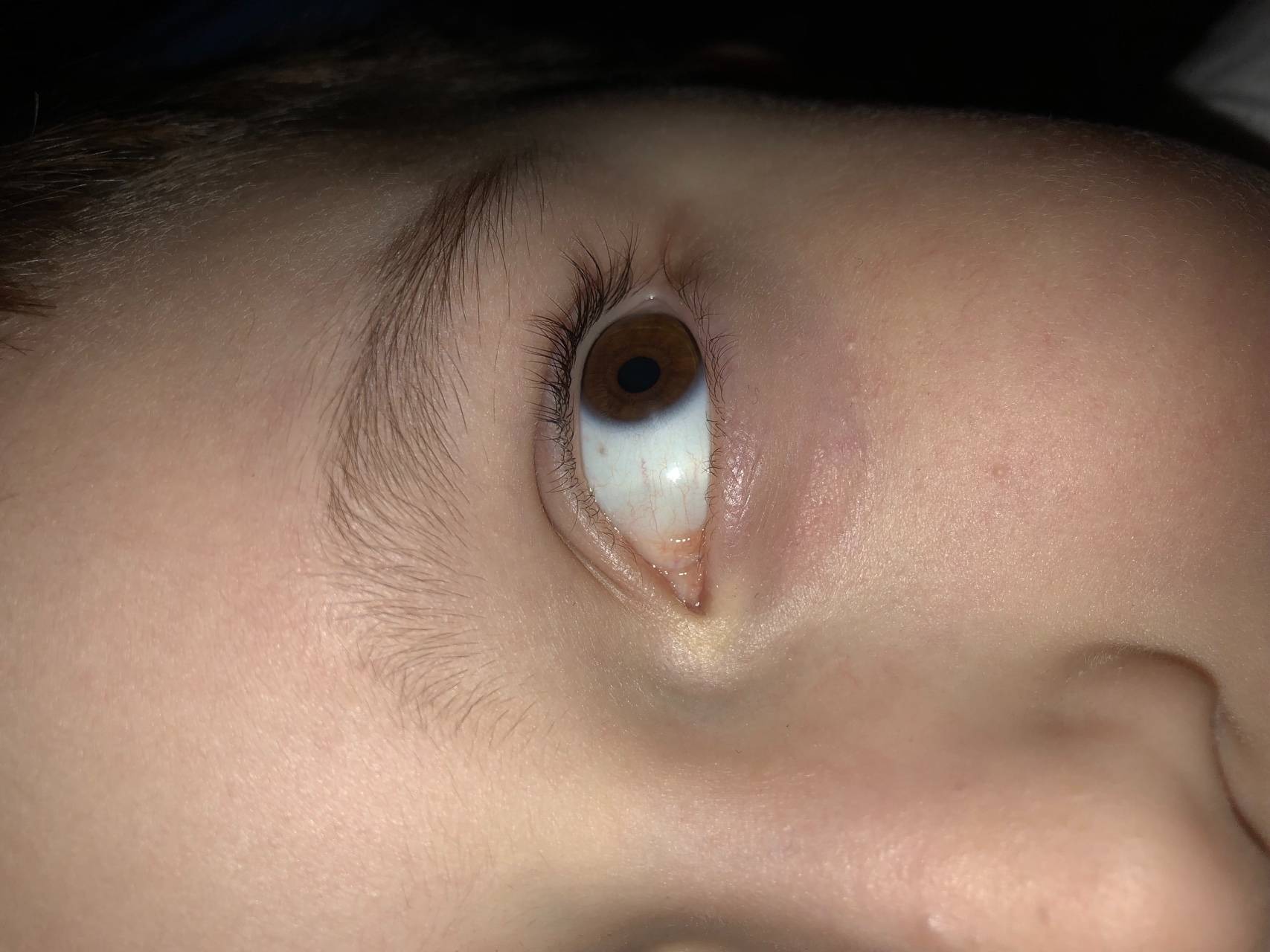 Голубой белок в глазах у детей. почему у ребенка серые белки глаз? синдром голубых склер – симптомы заболевания