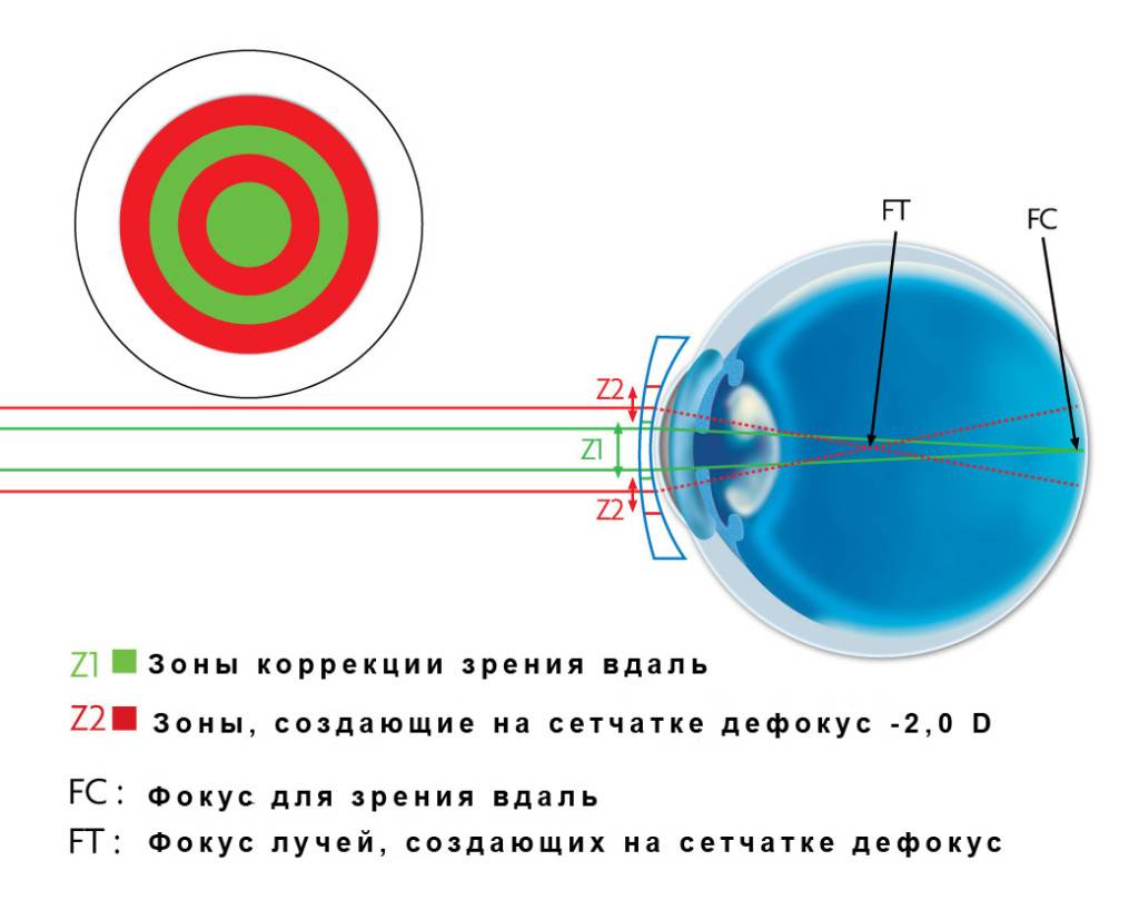 Мультифокальные линзы - что это такое, контактные для глаз и в очки: бифокальные, прогрессивные, multifocal