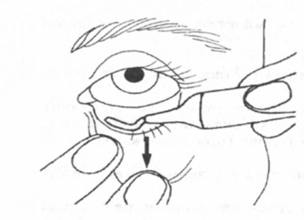 Как правильно закладывать тетрациклиновую мазь в глаза?