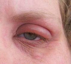 Воспаление на веке глаза – что делать, как и чем лечить, если покраснело и опухло