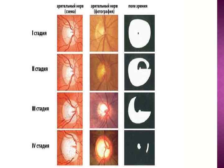 Нисходящая атрофия зрительного нерва: полная или частичная дегенерация нервных волокон приводит к инвалидности