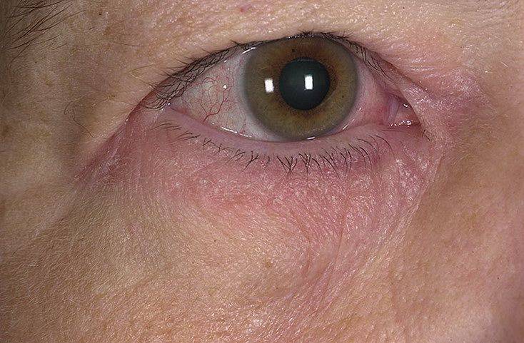 Почему появляются трещины и шелушение кожи вокруг глаз