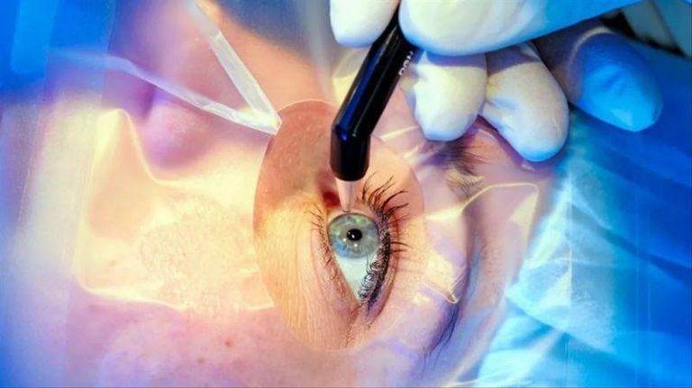 Как проводят чистку хрусталика глаза лазером