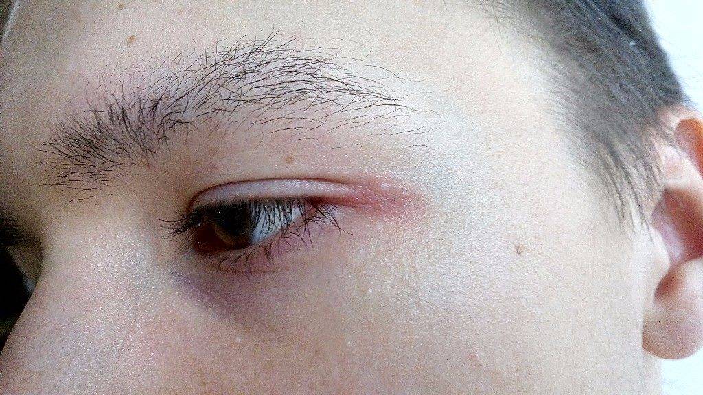 Раздражение вокруг глаз в уголках кожи на веках: лечение капли, симптомы