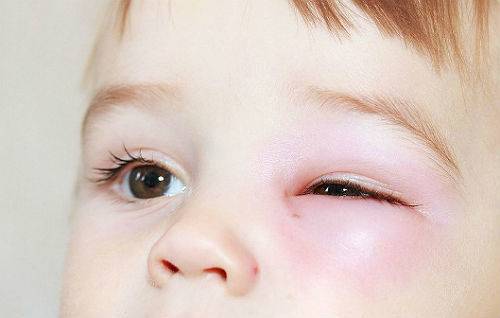 Лопнул сосуд в глазу у ребенка: когда следует обращаться к врачу