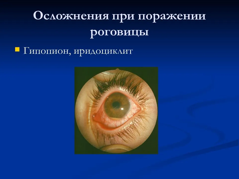 Удаление глаза у человека - как проводится, реабилитация
