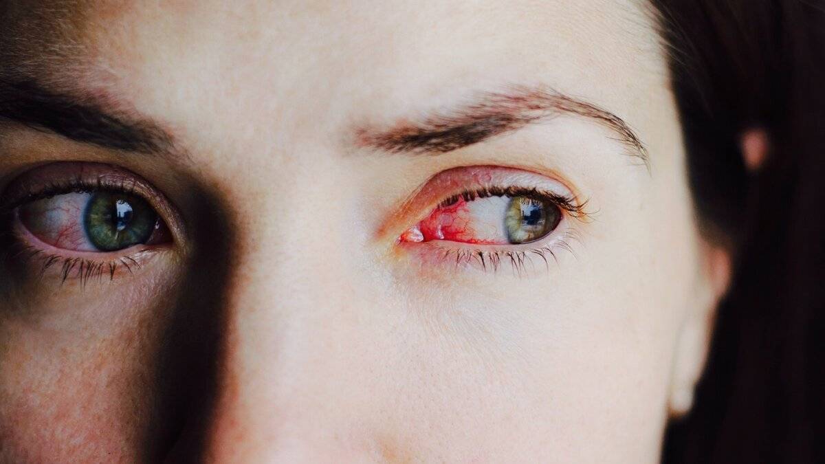 Синдром сухого глаза: 7 причин и способы лечения - лайфхакер