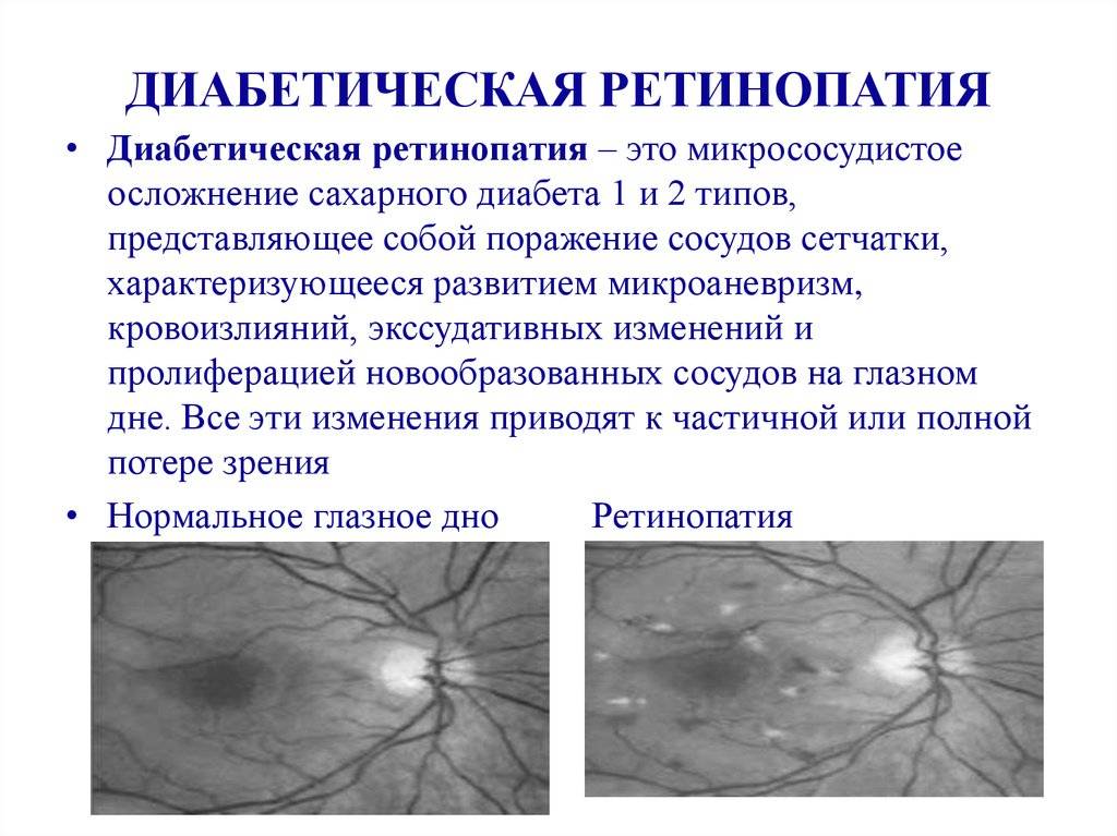 Диабетическая ретинопатия при сахарном диабете, ее симптомы