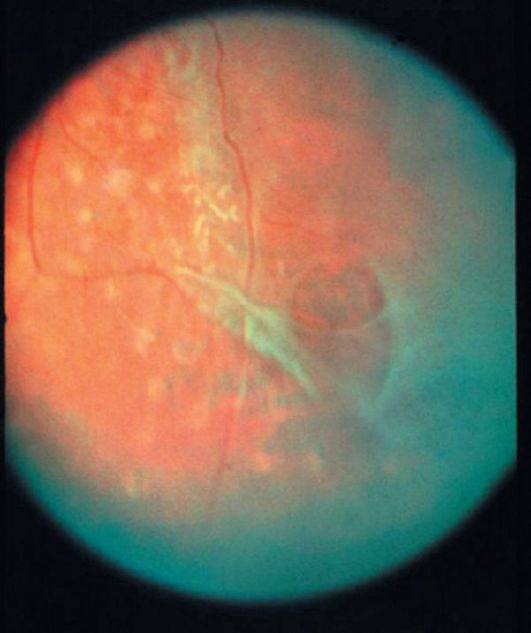 Ретиношизис сетчатки глаза: лечение, прогноз профилактика