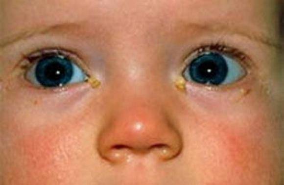 Гноится глаз у новорожденного: оказание первой помощи, рекомендации комаровского