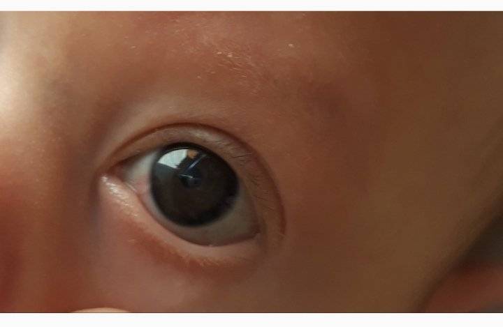 Восстановить роговицу глаза. лечение при повреждении роговицы глаза