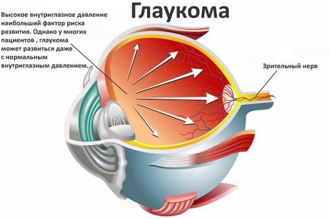 Лечение глаукомы