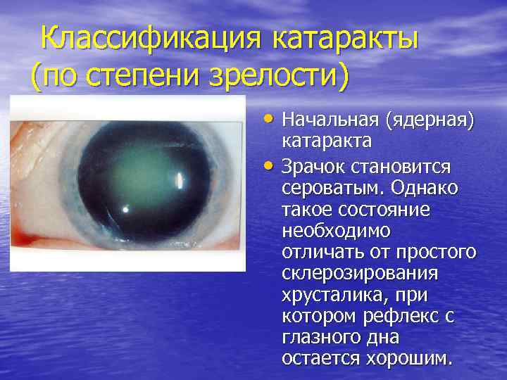Что такое катаракта: все о болезни и эффективном лечении