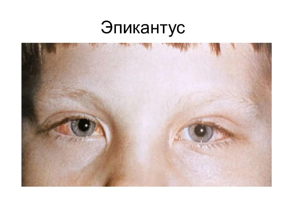 Эпикантус века (монгольская складка) на лице: лечение, причины и фото
