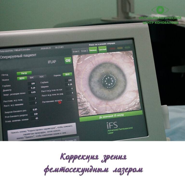 Фемтосекундное сопровождение хирургии катаракты | советы доктора