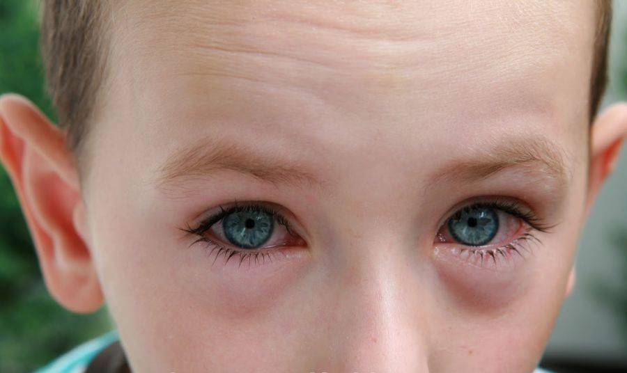 Насморк и красные глаза у ребенка: почему появляется заложенность носа, кашель и покраснение склер при простуде и орви