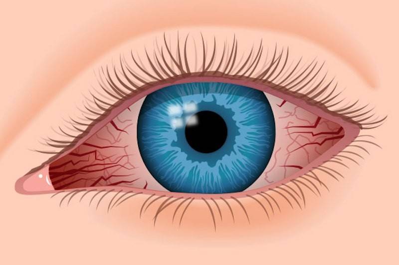 Ирит (болезнь глаз) - симптомы, причины, лечение, последствия