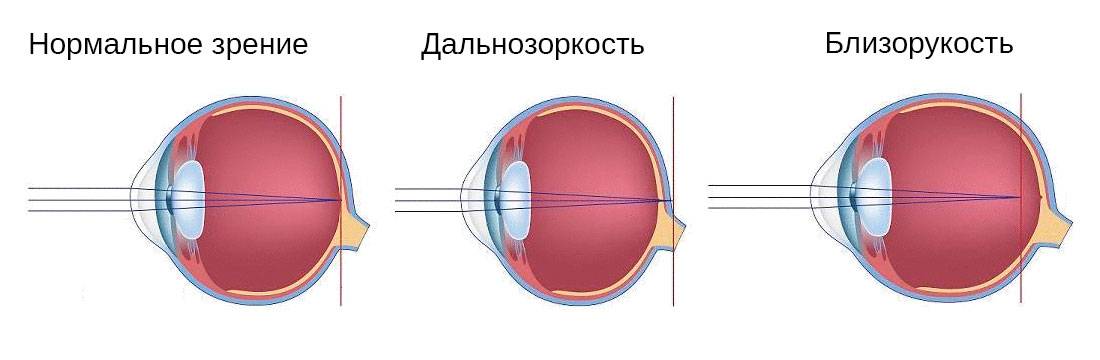 Близорукость одного глаза - причины односторонней миопии