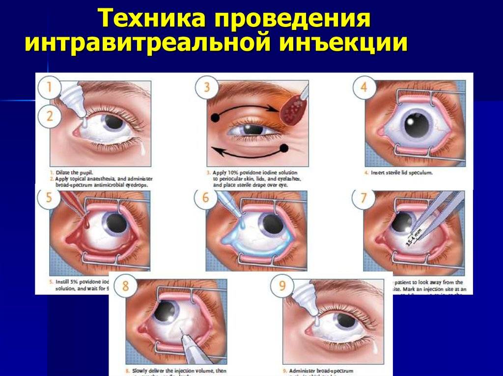 Субконъюнктивальная инъекция: как это делается, показания к введению укола и техника выполнения | malyshlandia.ru