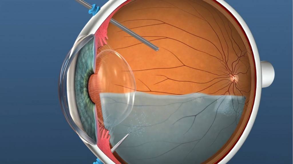 Причины и симптомы разрыва сетчатки глаза