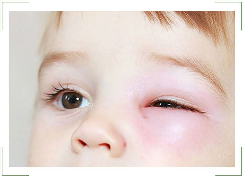 Воспалился глаз у ребенка без всякой на то причины что делать?