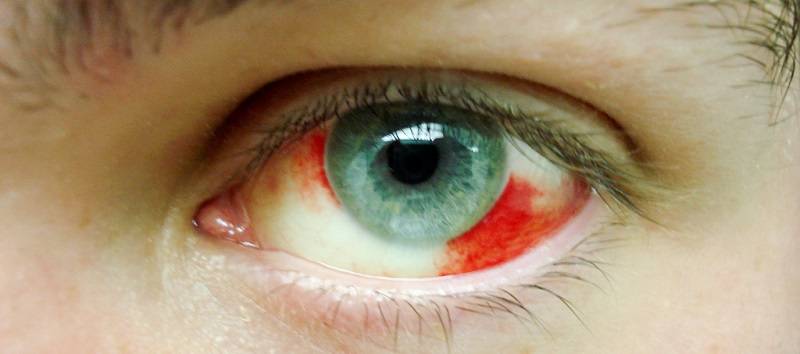 Кровоизлияние в глаз: причины и лечение, что делать, субконъюнктивальное, кровоточат, гемофтальм, в стекловидное тело, глазные капли, сетчатку, почему идет кровь, склеру, частичный
