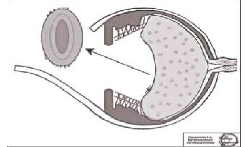 Интракапсулярная экстракция катаракты (иэк) с имплантацией иол