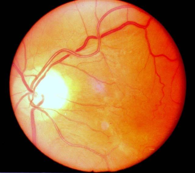 Ангиосклероз сетчатки глаза: симптомы и лечение - "здоровое око"