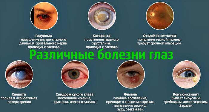 Болезни глаз: список патологий, которые возникают у человека, медицинские и народные названия