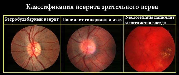 Неврит зрительного нерва | компетентно о здоровье на ilive