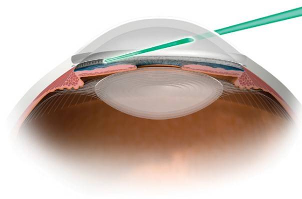 Как происходит лечение глаукомы лазером? в каком случае необходим хирургический метод?