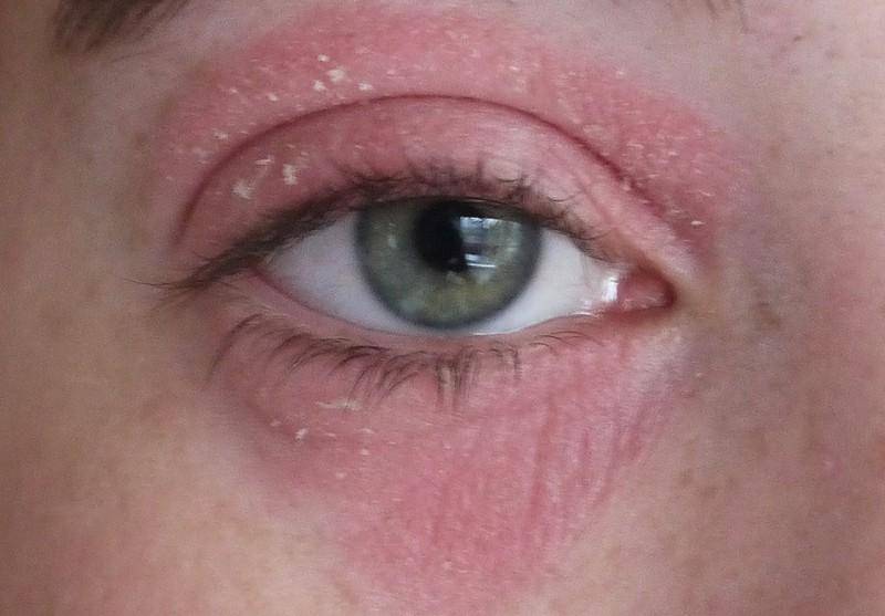 Аллергия на глазах: причины, симптомы и лечение