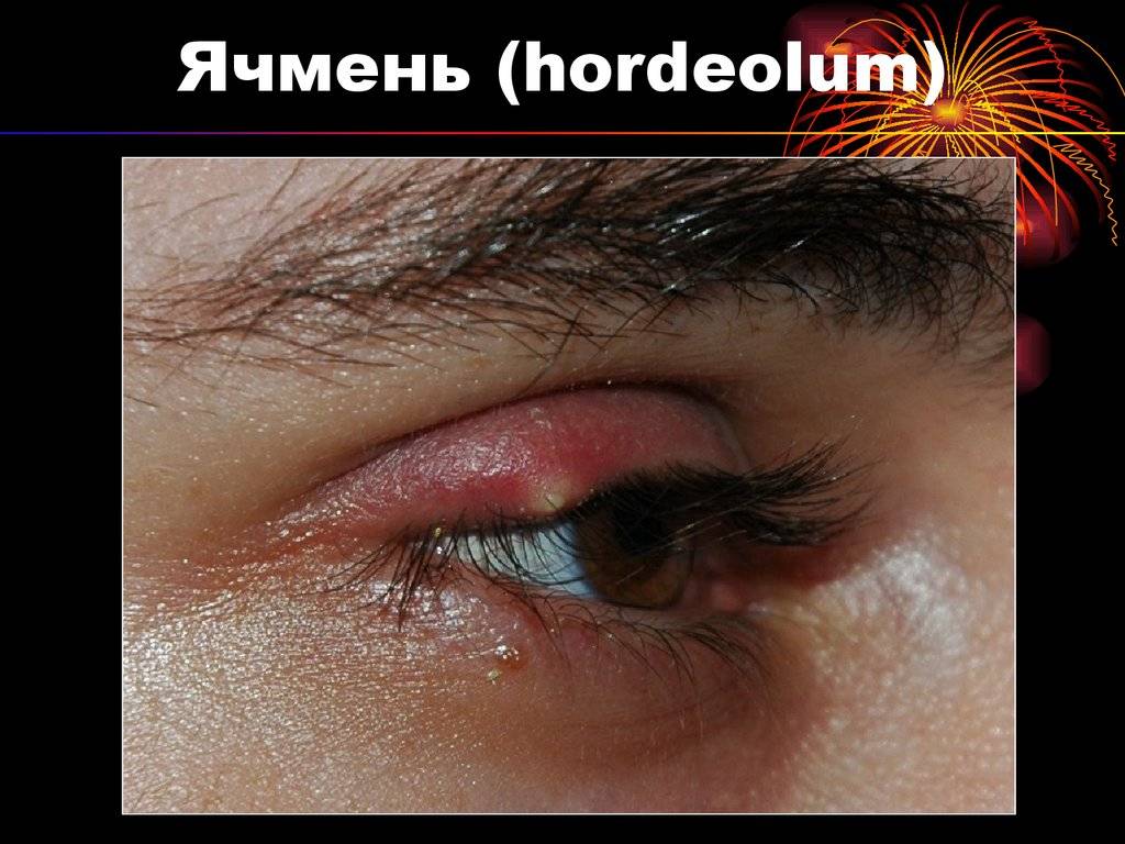 Наружный ячмень (hordeolum externum) - симптомы болезни, профилактика и лечение наружного ячменя (hordeolum externum), причины заболевания и его диагностика на eurolab